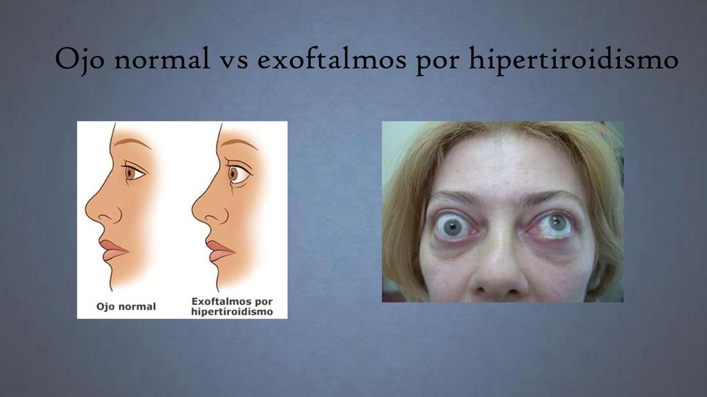 Del los efectos hipotiroidismo ojos en